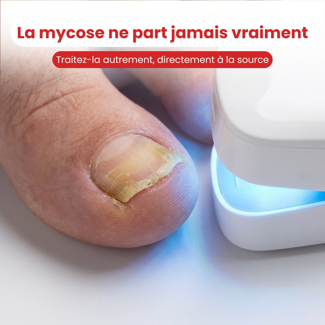 LumiPod™ — La Lumière Contre la Mycose
