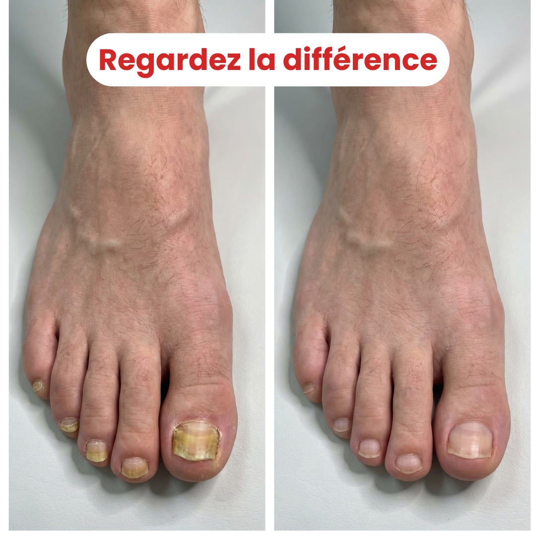 LumiPod™ — La Lumière Contre la Mycose